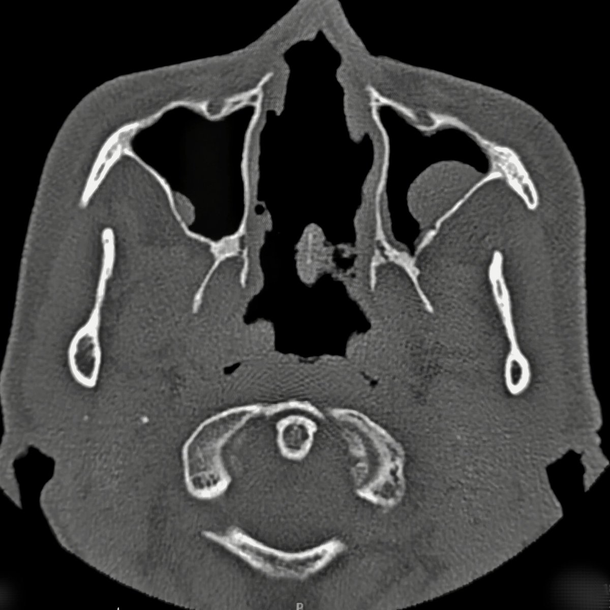 er_tramonto's tweet image. наркотики - зло! 💁

ж49, носовую перегородку и раковины пожрал кокс 😒