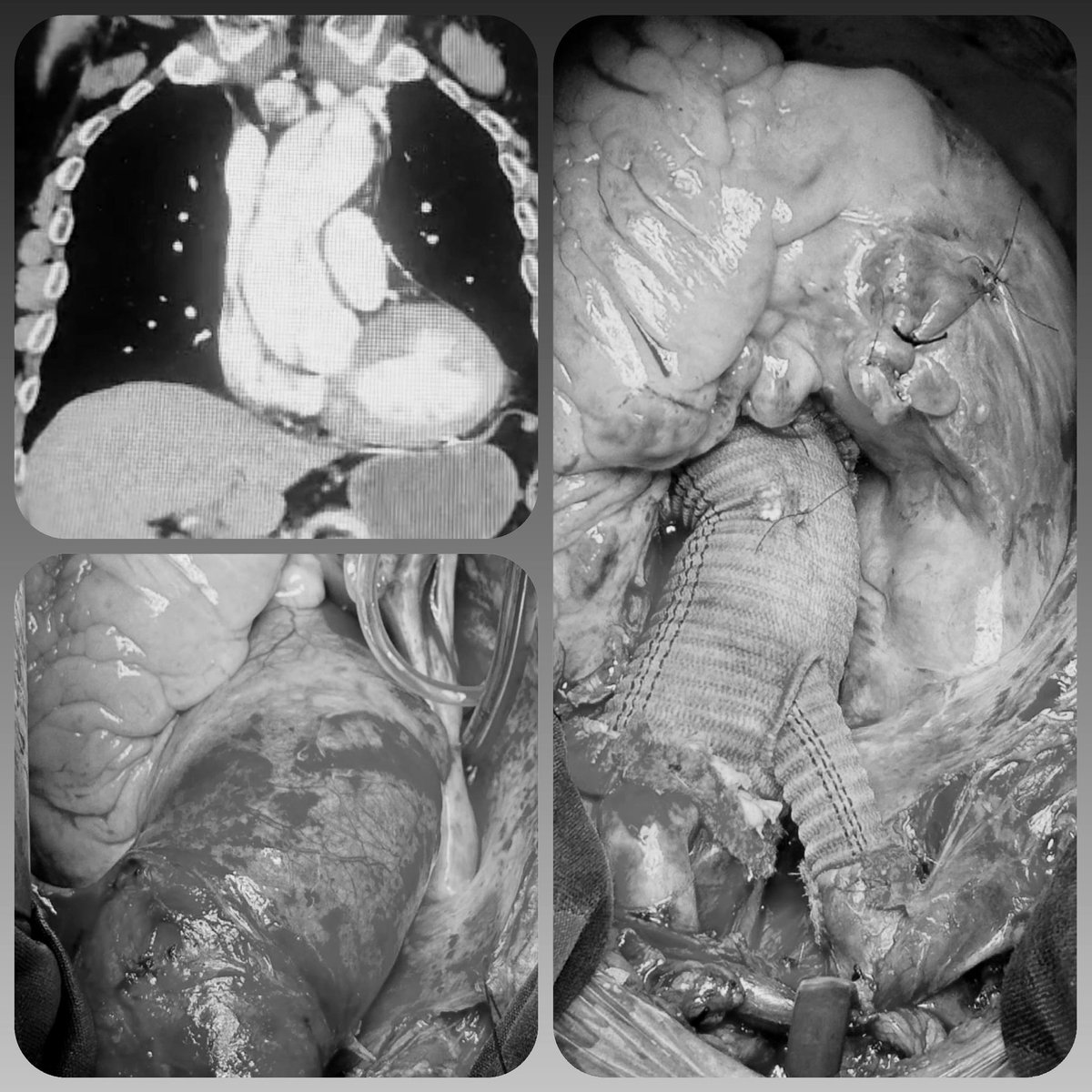 k_musayev's tweet photo. Type A Acute Aortic Dissection 
Zone 1 Total Arch Replacement 

#aorticsurgery  #totalarchreplacement #aorticdissection https://t.co/zSjLfL3n4N