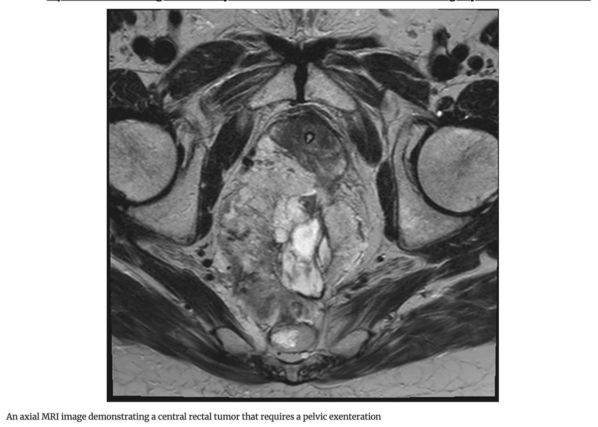 Annals of Surgical Oncology (@annsurgoncol) on Twitter photo June Issue: Operative Strategies for Beyond Total #MesorectalExcision Surgery for #RectalCancer
rdcu.be/eqUec
<a href="/AMVillanoMD/">Anthony Villano, MD</a>
<a href="/SyedAAhmad5/">Syed A. Ahmad</a> June Issue: Operative Strategies for Beyond Total #MesorectalExcision Surgery for #RectalCancer
rdcu.be/eqUec
<a href="/AMVillanoMD/">Anthony Villano, MD</a>
<a href="/SyedAAhmad5/">Syed A. Ahmad</a>