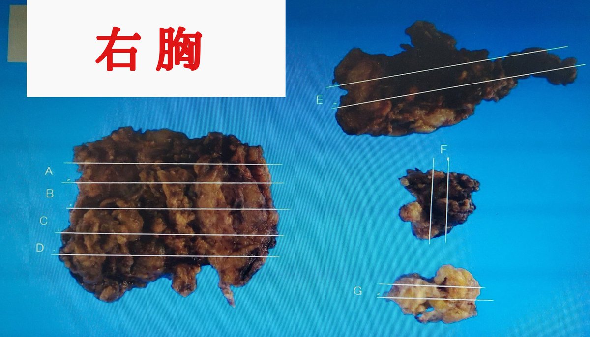 凍結脂肪要注意⚠️被害多⚠️エコーではなくMRI️検査を⚠️ tweet media