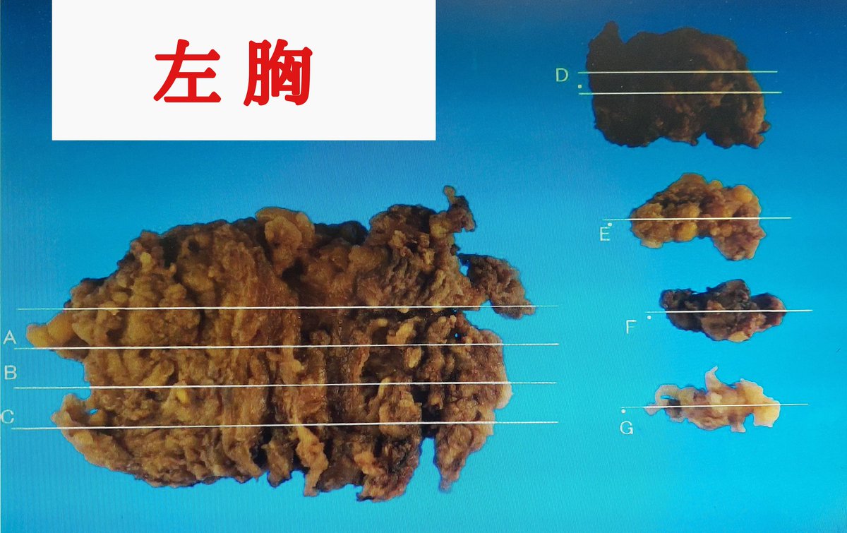 凍結脂肪要注意⚠️被害多⚠️エコーではなくMRI️検査を⚠️ tweet media