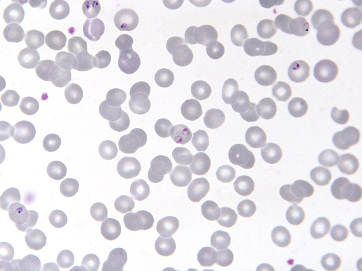 ParasiteGal's tweet photo. #Parasite case 779 is now up donated by Dr. Richard Bradbury: Giemsa-stained blood films and urine from a febrile patient in The Gambia recently treated with quinine. What is this condition and its cause? https://t.co/q0XHANymQe Ans later this week! #mayopath #pathology #PathBugs https://t.co/bNJ1NgmZtz