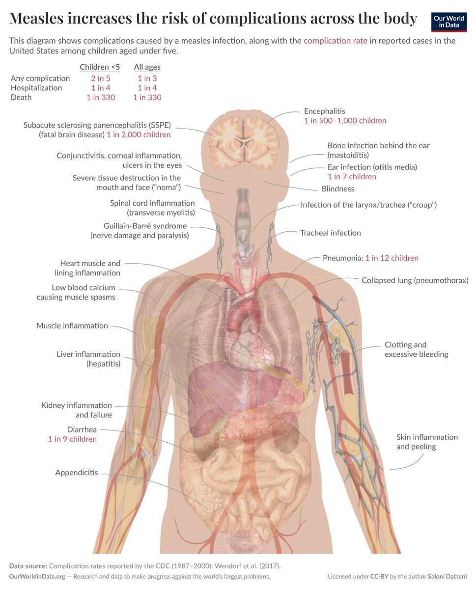 New piece by me!

Measles is often seen as a routine childhood illness: a fever, rashes, recovery. But complications are common.

Even when it doesn’t kill, measles causes lasting damage. It depletes immune cells, making people vulnerable to other infections for months or years.