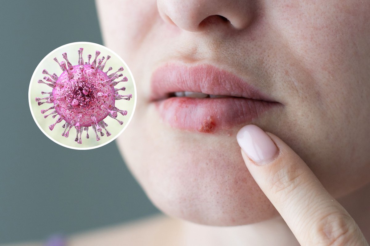 AspainEric's tweet photo. 📢LET'S TALK ABOUT #Ivermectin 
#Testimonials - 009 
➡️ Ivermectin treats #HerpesSimplex and #HerpesZoster
➡️ @meds4go
➡️ Ivermectin Inhibits Bovine Herpesvirus 1 DNA Polymerase Nuclear Import and Interferes With Viral Replication. BoHV-1 infection leads to lesions in the respiratory, nervous, reproductive, and digestive systems in infected-bovines

@MakisMD @DrAlexareyes @toobaffled @JohnDParody