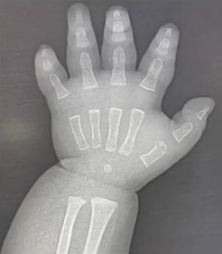 เอกซเรย์มือมังจุ้ด