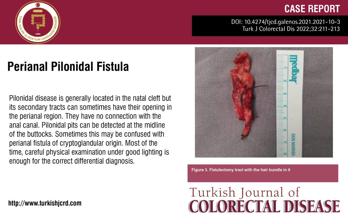 turkdiscolrect's tweet image. Perianal Pilonidal Fistula
You can see the free full text of the research by Gürel Neşşar et al.
Link : turkishjcrd.com/articles/peria…

#Perianal #fistula #pilonidal #disease #surgery
📷