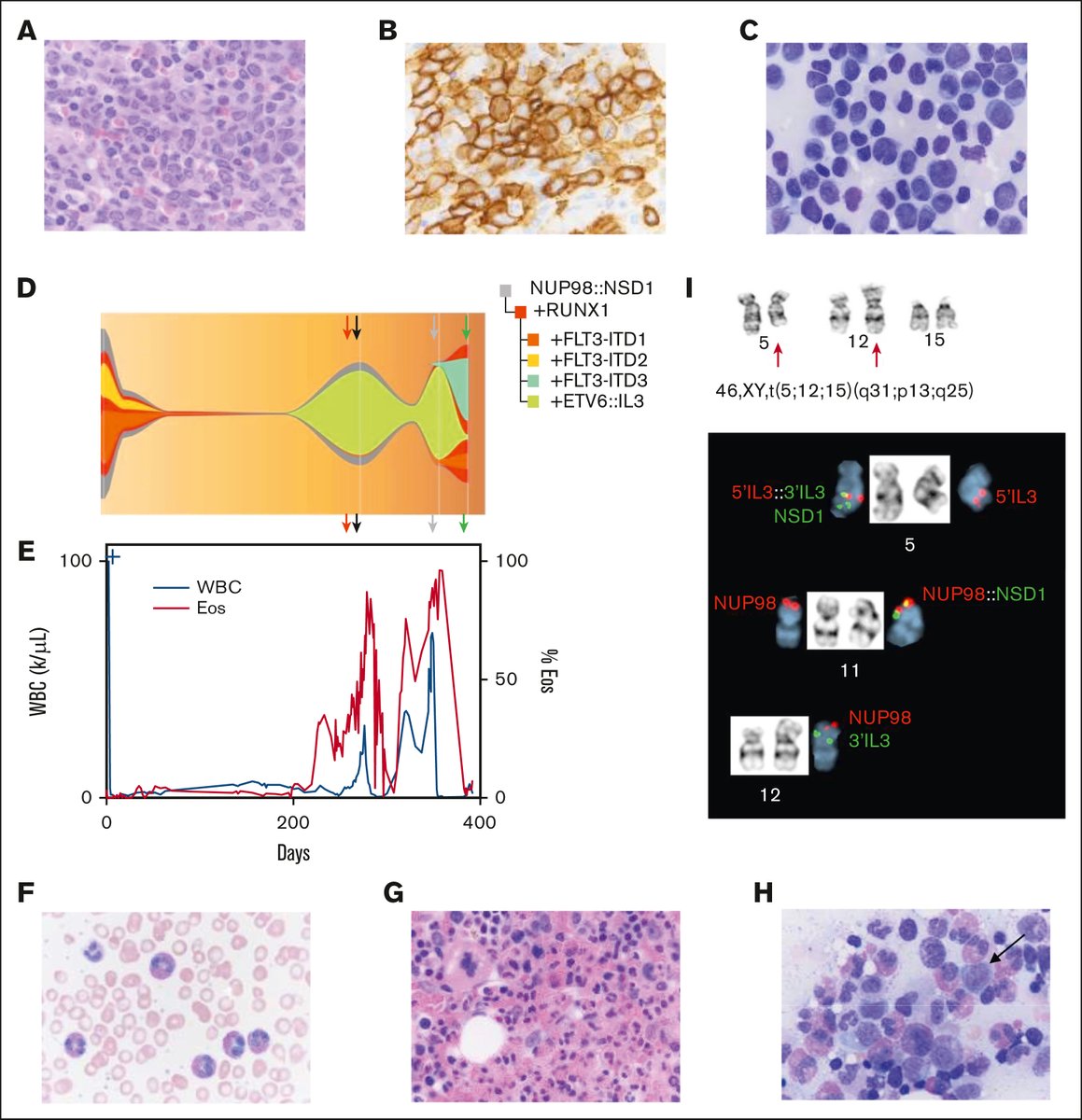 Bloodneoplasia's tweet image. Eosinophilia is seen in both reactive and clonal processes. In acute myeloid leukemia (AML), the presence of eosinophilia often represents underlying gene rearrangements. ow.ly/vXll50VVTKz #myeloidneoplasia