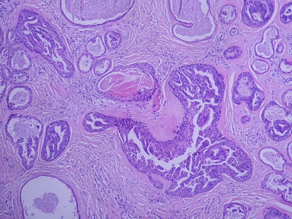 Papillary eccrine adenoma #dermPath #PathTwitter