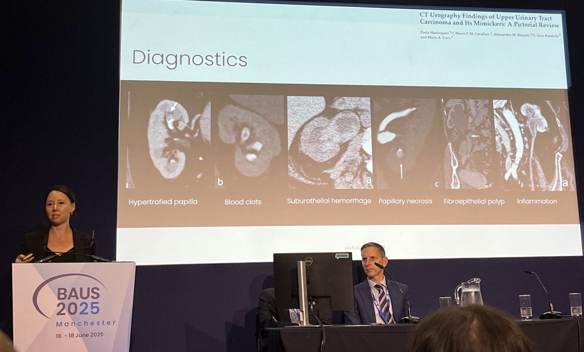 Daron Smith (@endoluminalendo) on Twitter photo Nice slide of CTU findings mimicking UTUC - welcome to #BAUS25 #JoyceBard
<a href="/lithohlr/">Hari Ratan</a> and the <a href="/BAUSendourology/">BAUS Endourology</a> team
<a href="/BAUSurology/">BAUS</a> Nice slide of CTU findings mimicking UTUC - welcome to #BAUS25 #JoyceBard
<a href="/lithohlr/">Hari Ratan</a> and the <a href="/BAUSendourology/">BAUS Endourology</a> team
<a href="/BAUSurology/">BAUS</a>