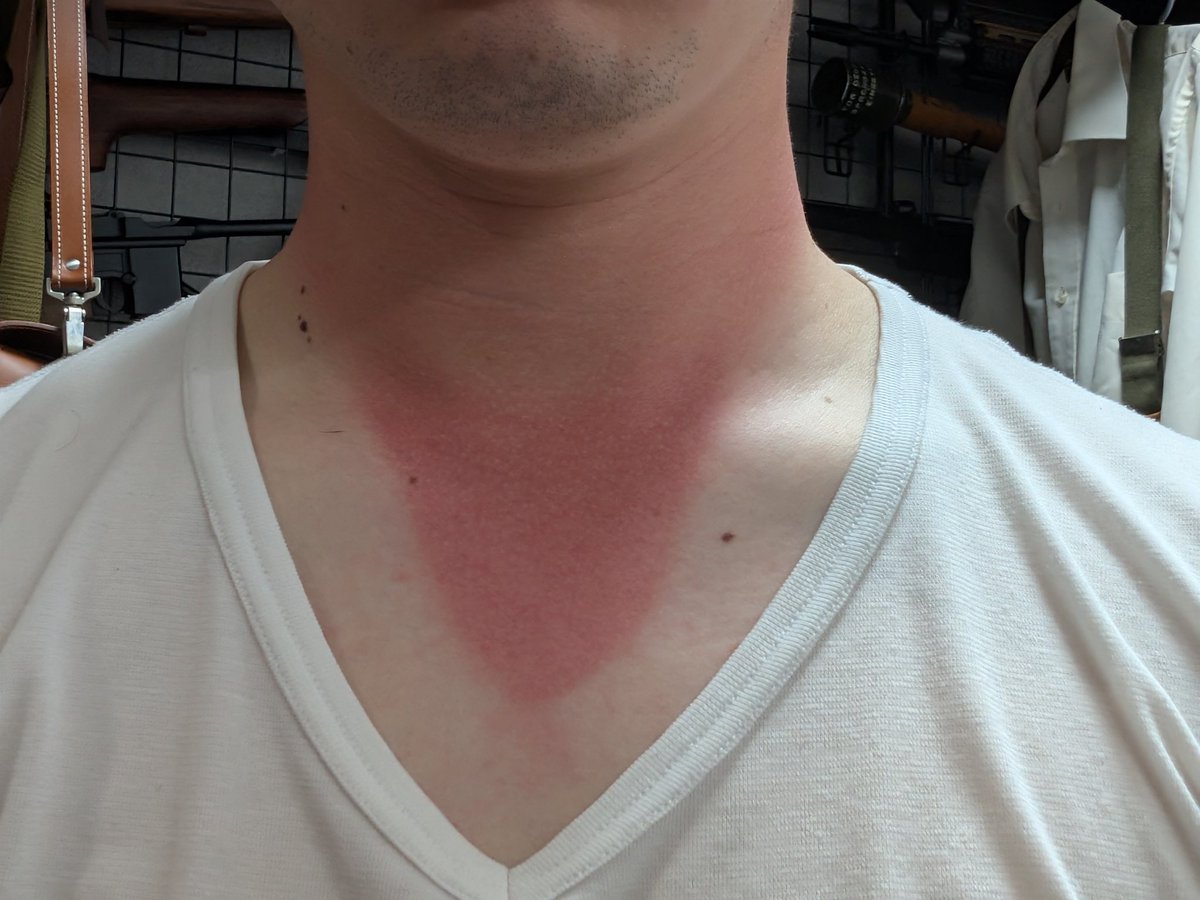 日焼け跡マヌケすぎ笑