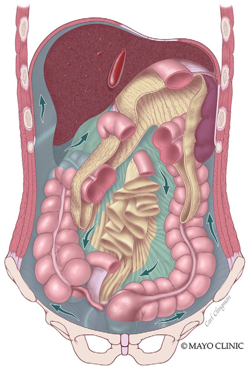 RadioGraphics (@radiographics) on Twitter photo This review highlights the radiologist’s key role in pseudomyxoma peritonei care—suggesting early diagnosis, optimizing imaging, and identifying disease sites that impact surgical success and guide treatment planning. bit.ly/3T5PtUW <a href="/JeffFidlerMD/">Jeff Fidler MD</a> <a href="/MRElastography/">Sudhakar Venkatesh MD (ಸುಧಾಕರ್ ವೆಂಕಟೆೇಶ್)</a> This review highlights the radiologist’s key role in pseudomyxoma peritonei care—suggesting early diagnosis, optimizing imaging, and identifying disease sites that impact surgical success and guide treatment planning. bit.ly/3T5PtUW <a href="/JeffFidlerMD/">Jeff Fidler MD</a> <a href="/MRElastography/">Sudhakar Venkatesh MD (ಸುಧಾಕರ್ ವೆಂಕಟೆೇಶ್)</a>