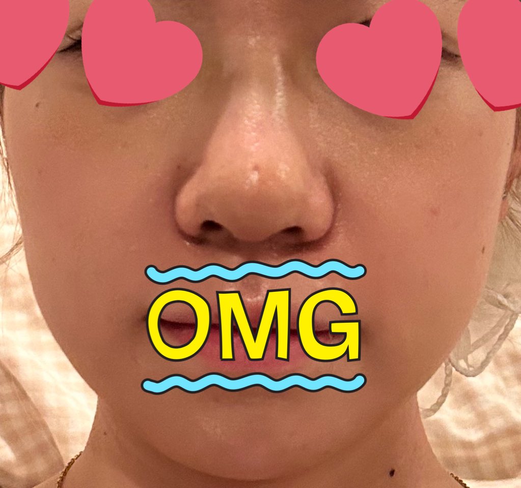 vo45vo's tweet photo. 鼻整形からもう1ヶ月！はや！ど
マジで腫れは絶対引くので安心してください😭

←ギプス外したて(術後1週間)
輪郭も鼻先もまん丸でX見ても術後腫れてない人しかいなくて毎日不安だったからDT中鬱の方の安心材料になりますように😭 両方ノーマル外カメ

まだ鼻先丸くて鬱だけど小さくなると信じてるよ https://t.co/Kzjnj2kcTj