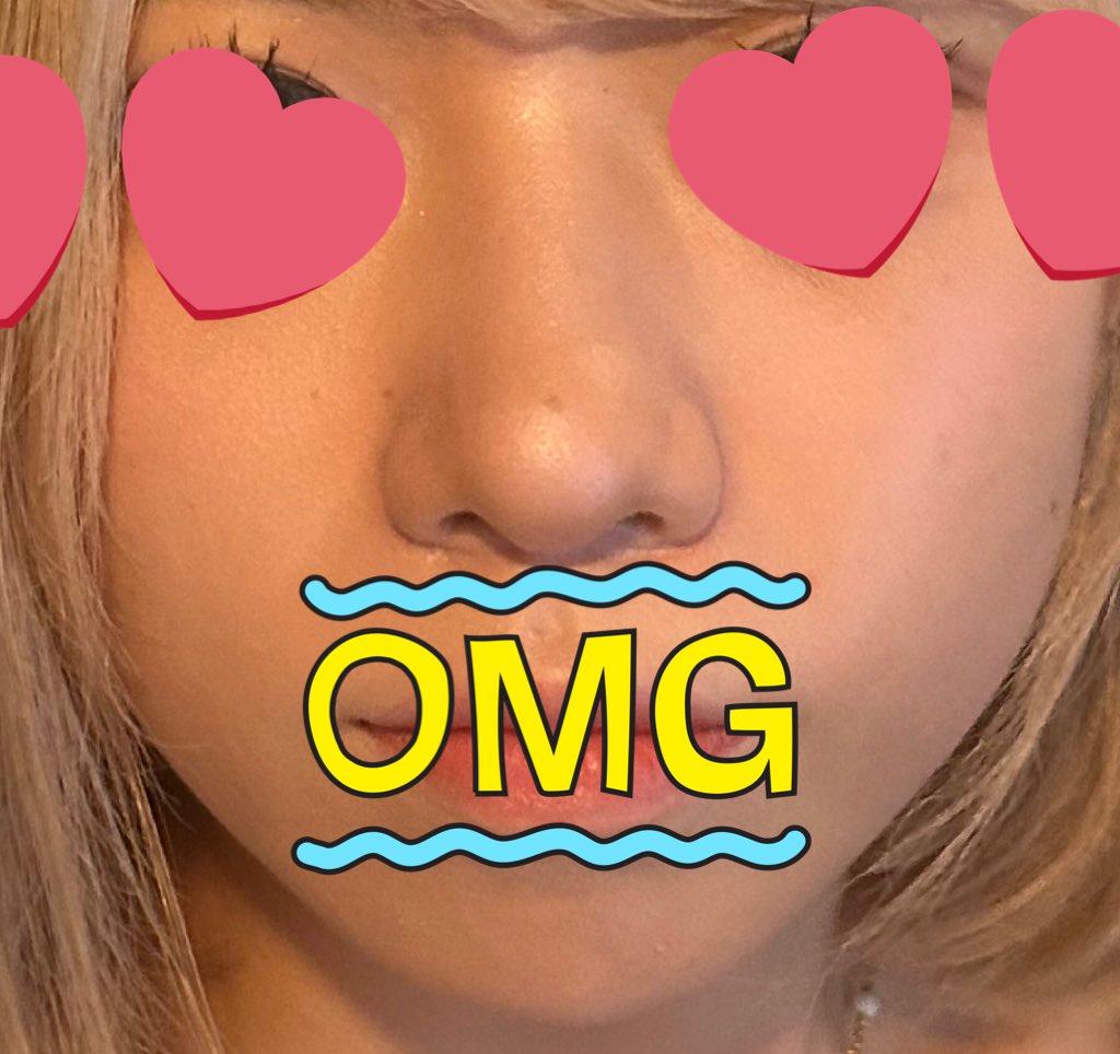 vo45vo's tweet photo. 鼻整形からもう1ヶ月！はや！ど
マジで腫れは絶対引くので安心してください😭

←ギプス外したて(術後1週間)
輪郭も鼻先もまん丸でX見ても術後腫れてない人しかいなくて毎日不安だったからDT中鬱の方の安心材料になりますように😭 両方ノーマル外カメ

まだ鼻先丸くて鬱だけど小さくなると信じてるよ https://t.co/Kzjnj2kcTj