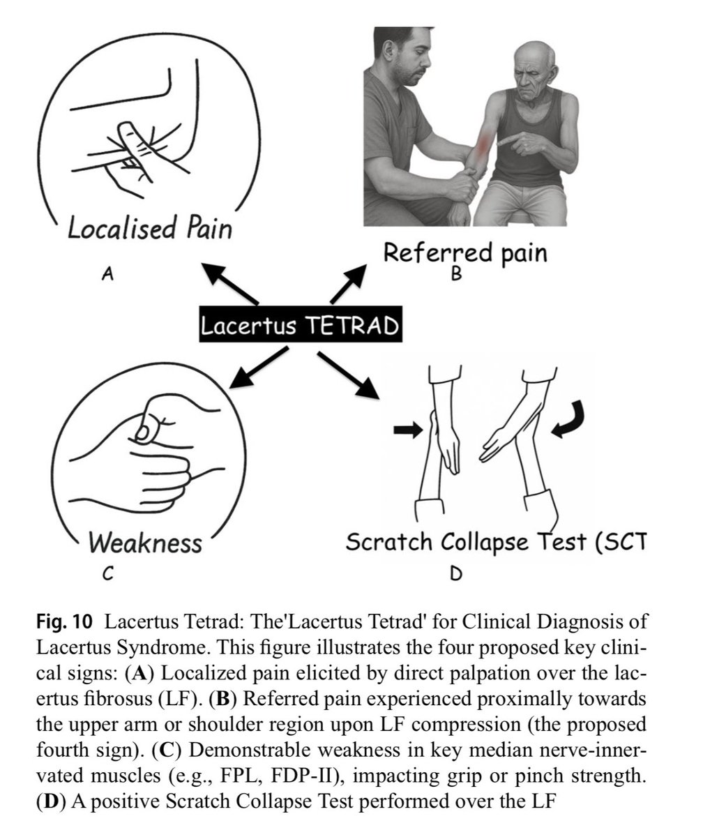 Terrence Jose Jerome, FRCS (@terrencejose) on Twitter photo Thrilled to share our article in International Orthopaedics (IF 2.6)
“Current Perspectives on Lacertus Syndrome”
Key features:Lacertus Tetrad, WALANT,Ultrasound doi.org/10.1007/s00264… <a href="/JHandSurg/">J Hand Surg Am- ASSH</a> <a href="/BSSHand/">British Society for Surgery of the Hand</a> <a href="/jbjs/">J Bone & Joint Surg</a> <a href="/prsjournal/">Plastic and Reconstructive Surgery</a> <a href="/PRSGlobalOpen/">PRS Global Open</a> <a href="/HandSurgeryAssn/">AAHS</a> <a href="/FESSHEurope/">FESSH</a> <a href="/BoneJointJ/">The Bone & Joint Journal</a> Thrilled to share our article in International Orthopaedics (IF 2.6)
“Current Perspectives on Lacertus Syndrome”
Key features:Lacertus Tetrad, WALANT,Ultrasound doi.org/10.1007/s00264… <a href="/JHandSurg/">J Hand Surg Am- ASSH</a> <a href="/BSSHand/">British Society for Surgery of the Hand</a> <a href="/jbjs/">J Bone & Joint Surg</a> <a href="/prsjournal/">Plastic and Reconstructive Surgery</a> <a href="/PRSGlobalOpen/">PRS Global Open</a> <a href="/HandSurgeryAssn/">AAHS</a> <a href="/FESSHEurope/">FESSH</a> <a href="/BoneJointJ/">The Bone & Joint Journal</a>
