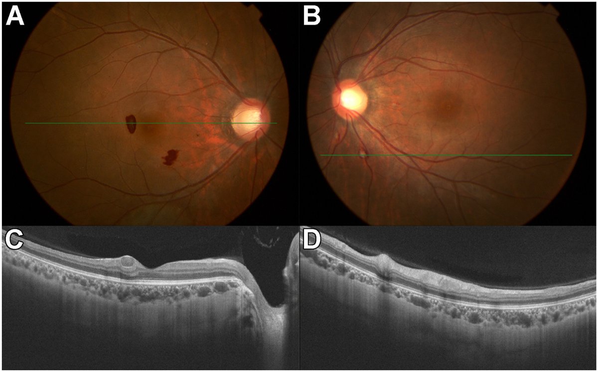 AAOjournal's tweet image. 31-year-old man w/ recurrent fever, scleritis &amp;amp; pulmonary infiltrates was diagnosed with VEXAS syndrome after genetic testing showed UBA1 mutation. Fundus exam revealed bilateral Roth spots; OCT showed cystic changes &amp;amp; microinfarction in nerve fiber layer
ow.ly/J7lE50VUURz