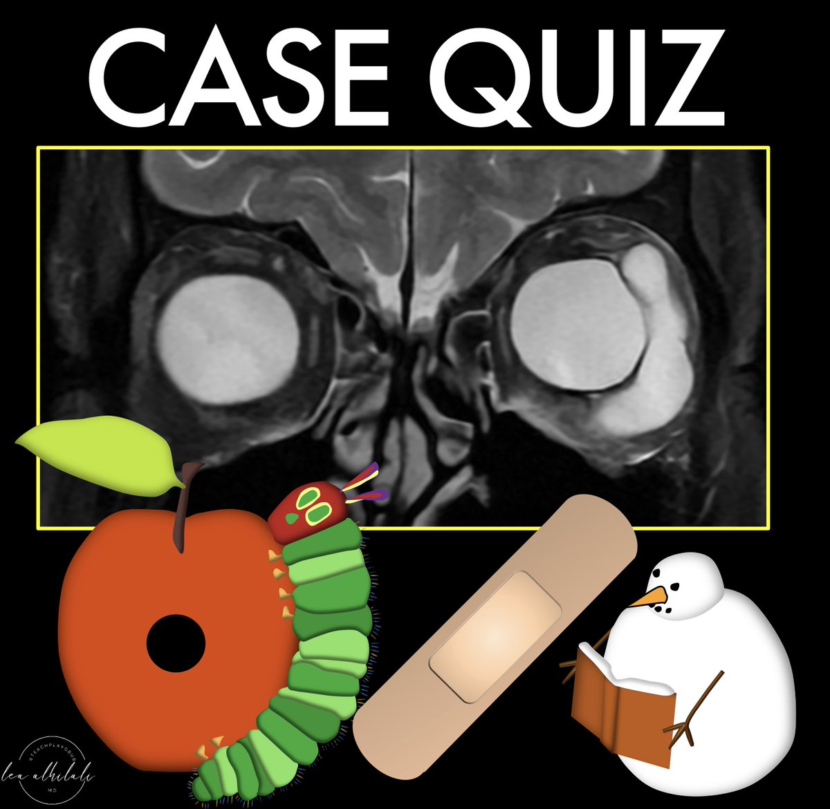 1/Just because the finding is obvious doesn’t mean the case is easy!

Here’s a thread about an interesting case that takes no time to make the finding, but a lot of time to get the diagnosis!