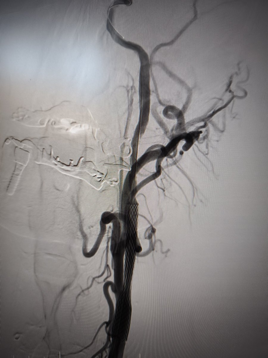Thrombous at the tip of the iNstroke catheter <a href="/CARDIVAGROUP/">CARDIVA</a> <a href="/iVascularGlobal/">iVascular</a> and ICA stenting.