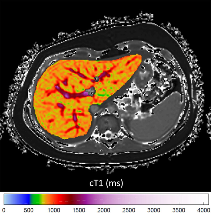 This review describes the acquisition, postprocessing, and analysis of T1 maps in the abdomen and explores applications in the liver, spleen, pancreas, and kidney.

ajronline.org/doi/10.2214/AJ…