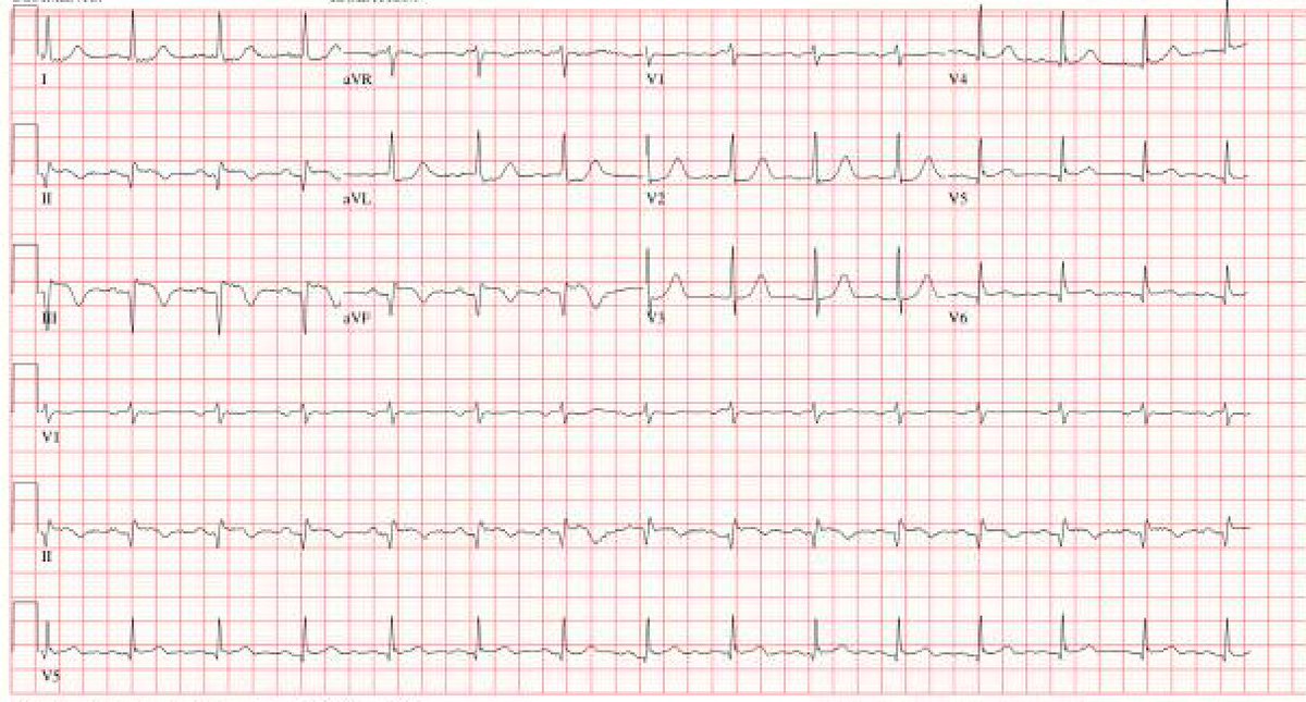 joshwangmd's tweet image. a classic inferior AST-elevation MI presenting with chest pain, nausea, and vomiting
AST 201 U/L (ULN = 35)