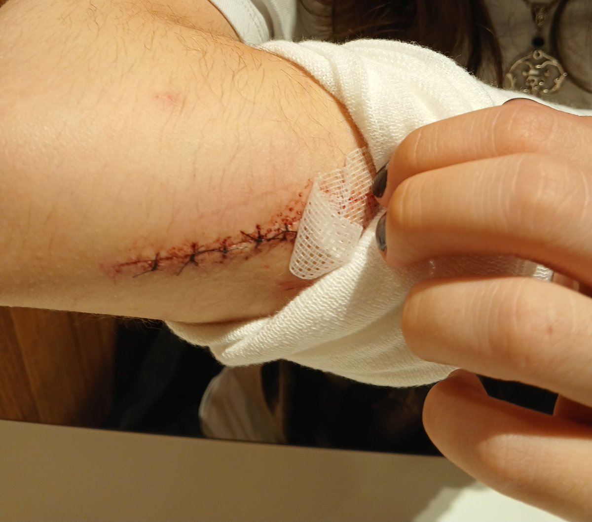 deathlyblessd's tweet photo. First stitches!!! #shtw #stitches #goretwt https://t.co/WvPZVdsNxr