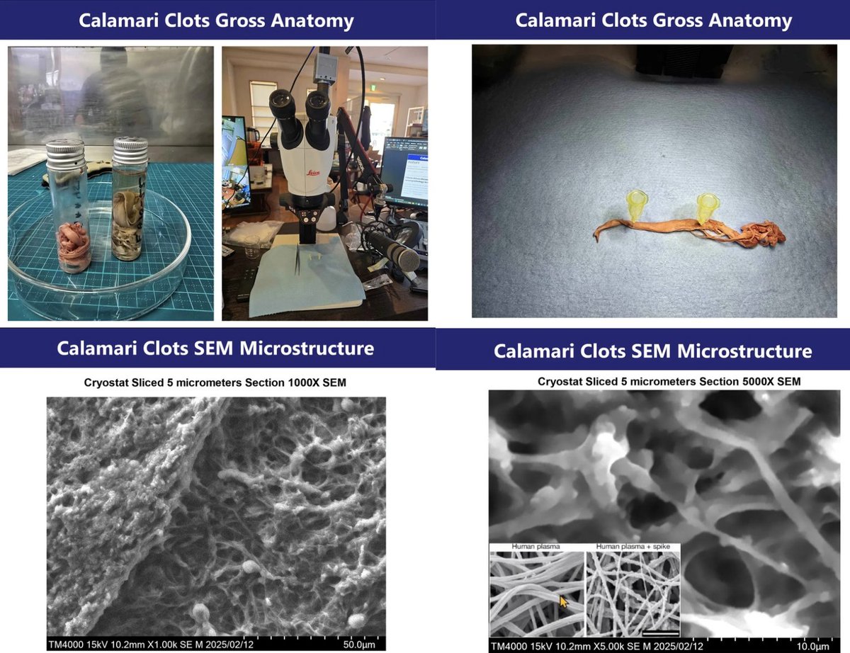 NicHulscher's tweet image. White Fibrous Clots Are REAL and PREVALENT

✅ Video-confirmed testimony of white fibrous clot detection by a majority of embalmers at an official state funeral directors association meeting

✅ 3 years of global embalmer survey data revealing widespread detection of white…