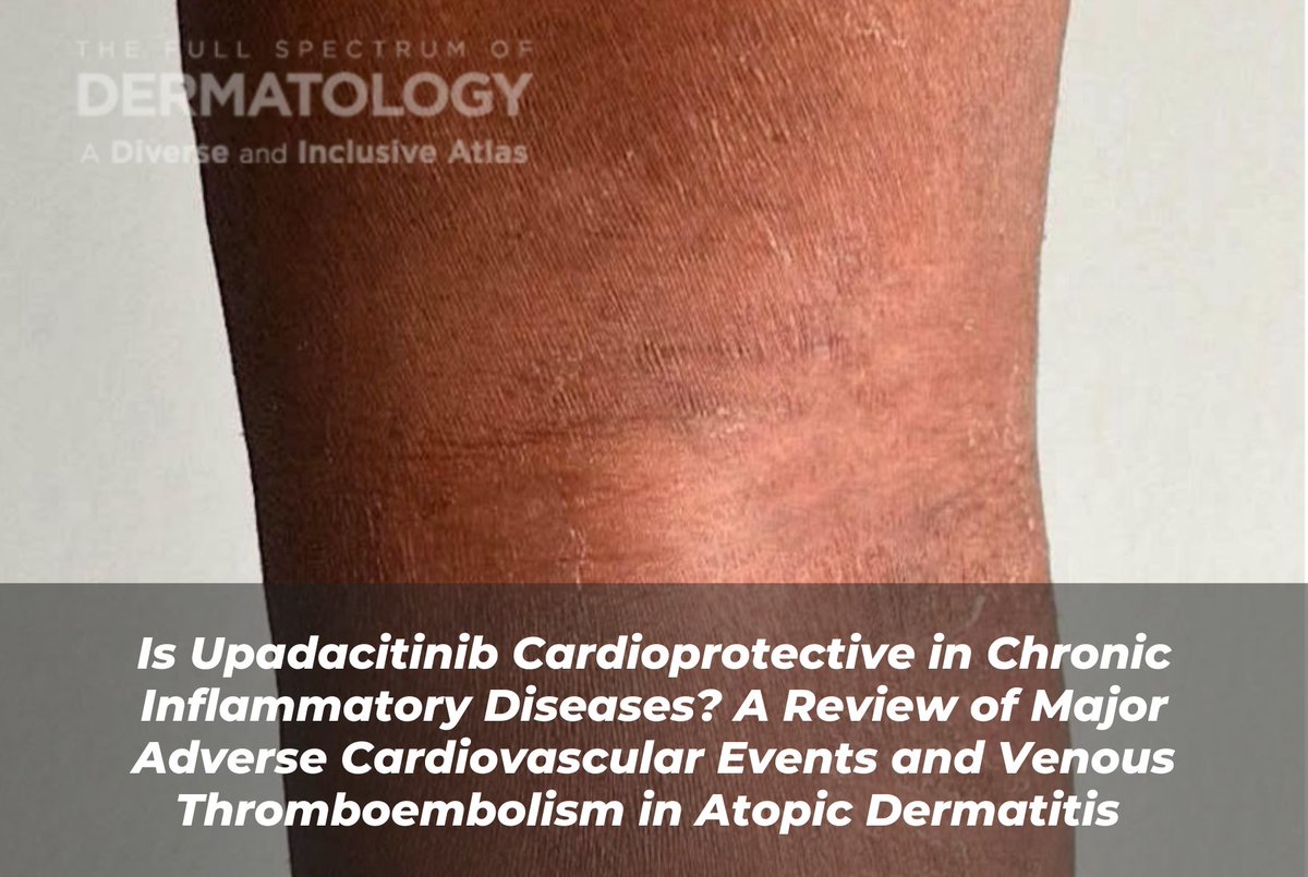 Journal of Drugs in Dermatology (JDD) (@jddonline) on Twitter photo 📌🫀 Could an Eczema Treatment Also Protect the Heart? Looking at Upadacitinib and Cardiovascular Risk 
READ MORE: jddonline.com/articles/upada… 📌🫀 Could an Eczema Treatment Also Protect the Heart? Looking at Upadacitinib and Cardiovascular Risk 
READ MORE: jddonline.com/articles/upada…