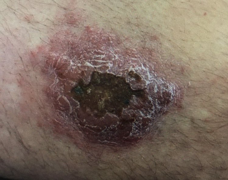 🔍 #MondayCaseReport
Quin és el diagnòstic més probable en un pacient amb espondilitis anquilopoiètica?
I el menys probable?

🧩 Opcions:
– Lupus vulgaris
– Leishmaniosi cutània
– Reactivació del VVZ
– Esporotricosi
– Mycobacterium marinum

T’atreveixes? Deixa la teva resposta 👇