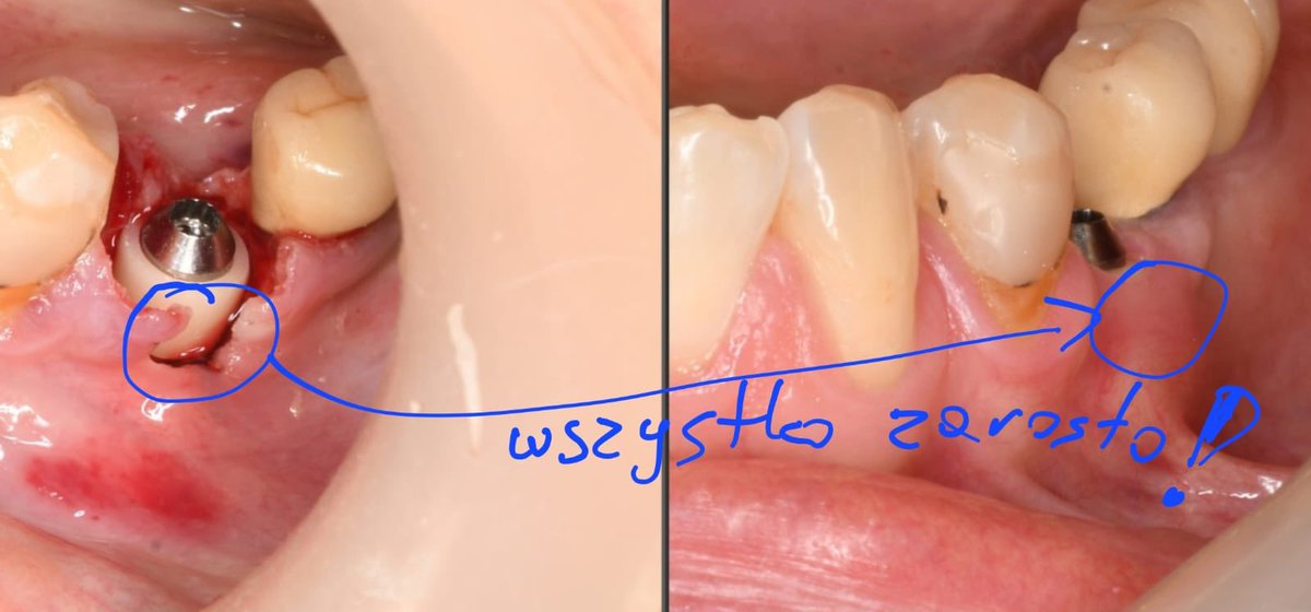 Mamy coraz więcej obserwacji po zastosowaniu hydrożelu chitozanowego w stomatologii.
Po lewej zdjęcie przed zastosowaniem hydrożelu, a po prawej efekt po około 4 miesiącach. 
Resztę na zdjęciu opisał nam lekarz🫣