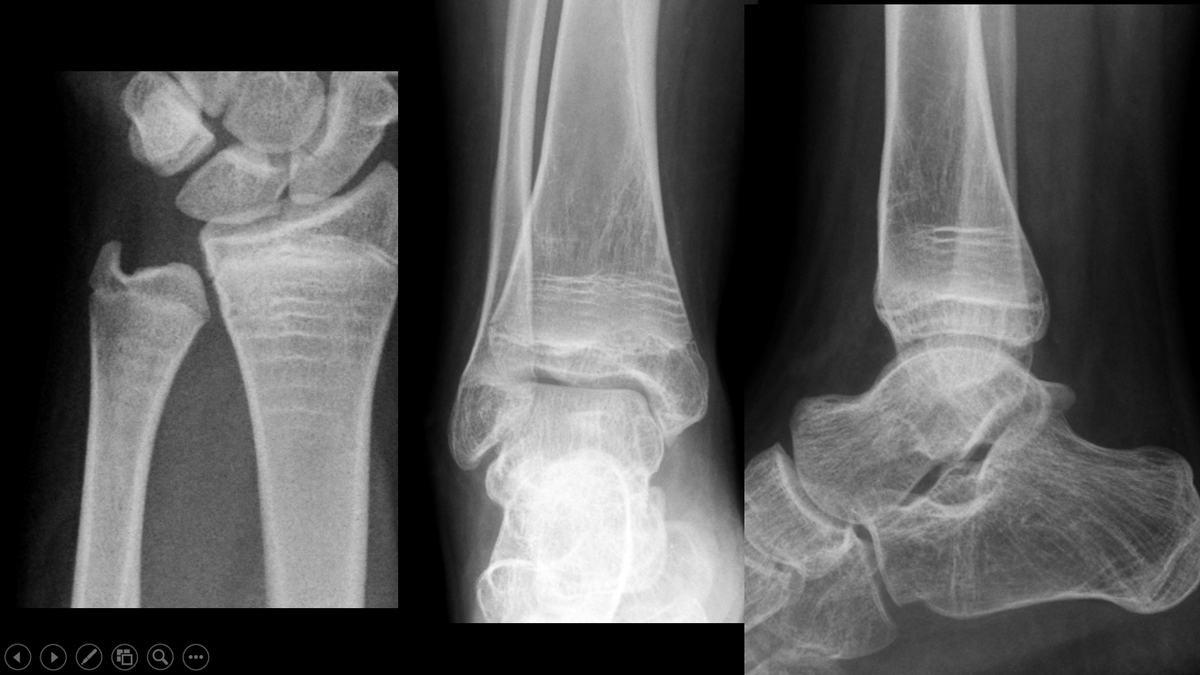 Bisphosphonate-induced epiphyseal zebra lines. A 15-year-old male receiving pamidronate treatment for osteogenesis imperfecta for four years.