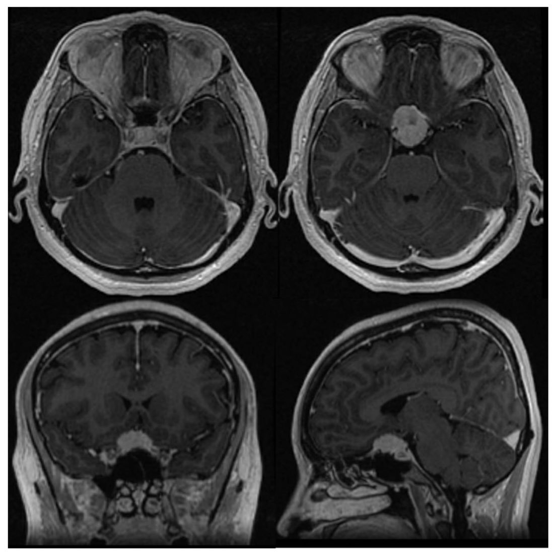 ActaNeuro's tweet image. #OnlineFirst: Effect of routine extradural optic canal decompression performed by skull base trained surgeons on visual outcomes in patients with anterior skull base meningiomas
Check out the #OpenAccess Acta Neurochirurgica Article at: link.springer.com/article/10.100…
#actaneuro