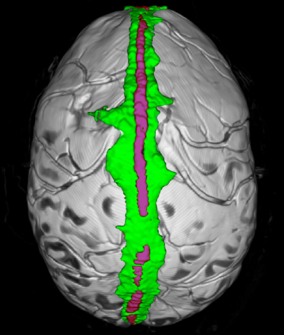 Donahue et al. review the anatomy and function of the parasagittal dural space, highlighting its roles in neurofluid egress, neuroimmune surveillance, and in the clearance of proteins implicated in neurodegenerative disorders. tinyurl.com/mpwbzax4
