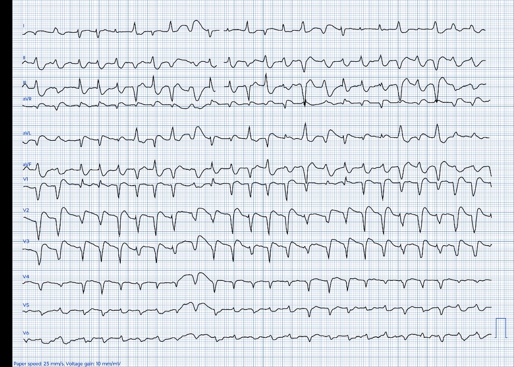 EkgHacks's tweet image. I got this pretty trace without more data! What should we call this?