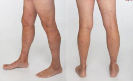 Medical image: Large local reactions to mosquito bites, also known as skeeter syndrome, are manifested as large, pruritic, and erythematous cutaneous lesions shortly after an arthropod bite.
mayocl.in/4481QVD