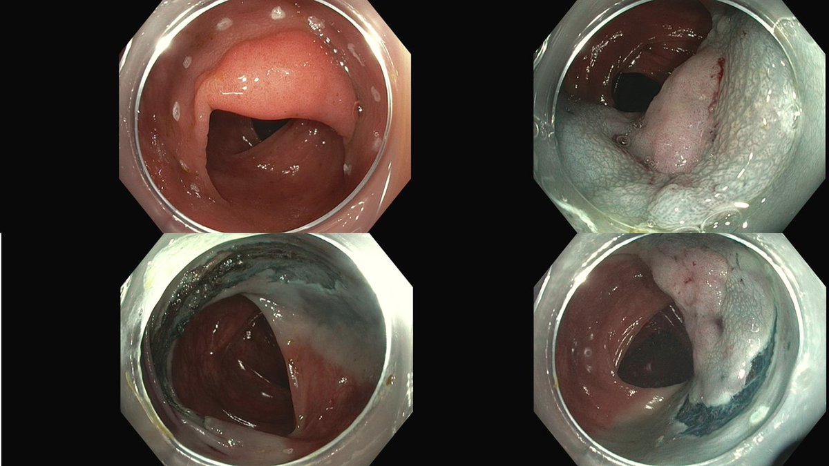 🏆ESD is a winner here! Despite challenging morphology, irregular surface, nongranular LST, fold convergence &amp; non-lifting sign ESD achieved complete en bloc resection where piecemeal EMR would've failed to answer critical question!. Can this be curative resection #ESD #GITwitter