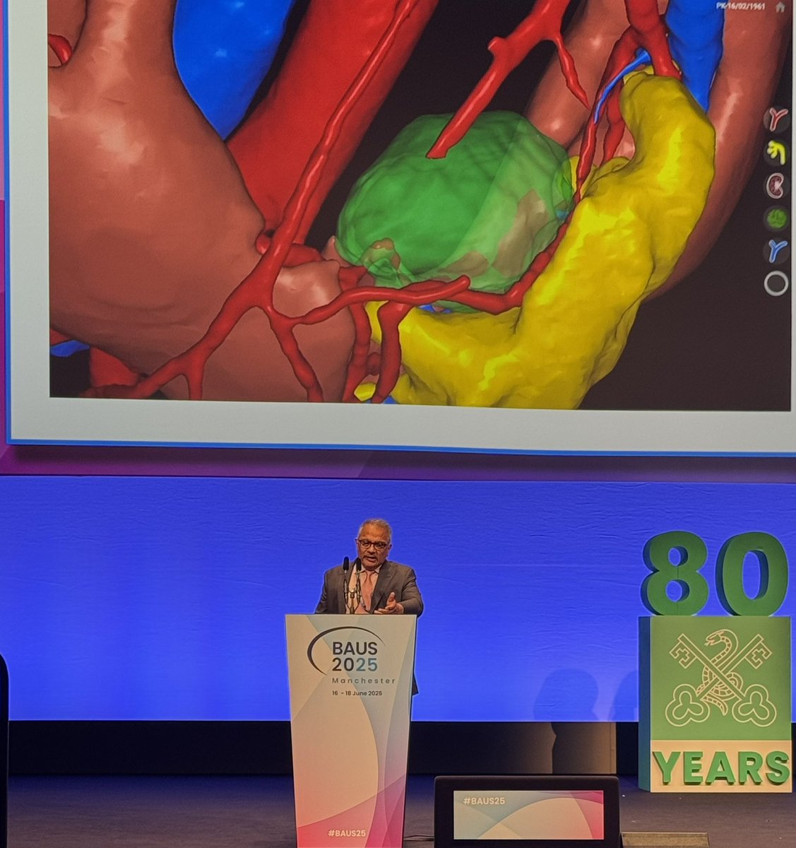 Ravi Barod (@ravibarodurol) on Twitter photo strong start for specialist centre for kidney cancer <a href="/RoyalFreeNHS/">Royal Free London</a> on day 1 at #BAUS25
David Cullen, lead kidney cancer CNS, speaking on personalised cancer care
Faiz Mumtaz, surgeon/ fellowship lead. speaking on AI & 3D recon to facilitate kidney cancer surgery
what a team! strong start for specialist centre for kidney cancer <a href="/RoyalFreeNHS/">Royal Free London</a> on day 1 at #BAUS25
David Cullen, lead kidney cancer CNS, speaking on personalised cancer care
Faiz Mumtaz, surgeon/ fellowship lead. speaking on AI & 3D recon to facilitate kidney cancer surgery
what a team!