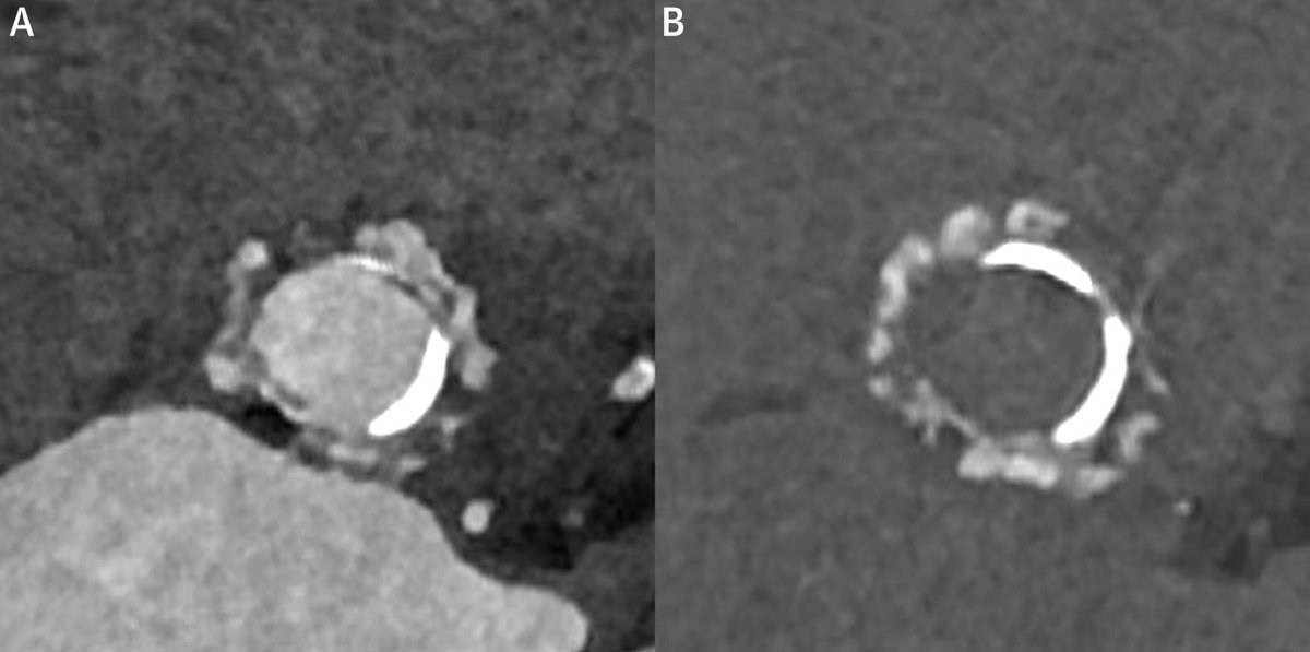 A new multisociety expert consensus document provides a brief overview of heart valve replacement techniques and available imaging techniques for prosthetic heart valve assessment.

Get the details in #JACC: jacc.org/doi/10.1016/j.… #YesCCT #cvImaging