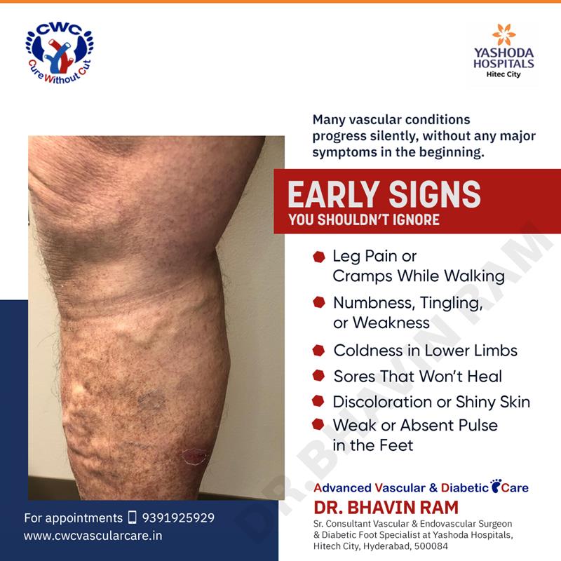 DrBhavinRam1's tweet image. Vascular disease often develops quietly, but its impact can be life-changing. Being mindful of your body’s subtle changes can make all the difference. 
bit.ly/3hfmJdi
#VascularHealth #CirculationMatters #SilentSymptoms #VascularAwareness #HealthyBloodFlow @drbhavinram