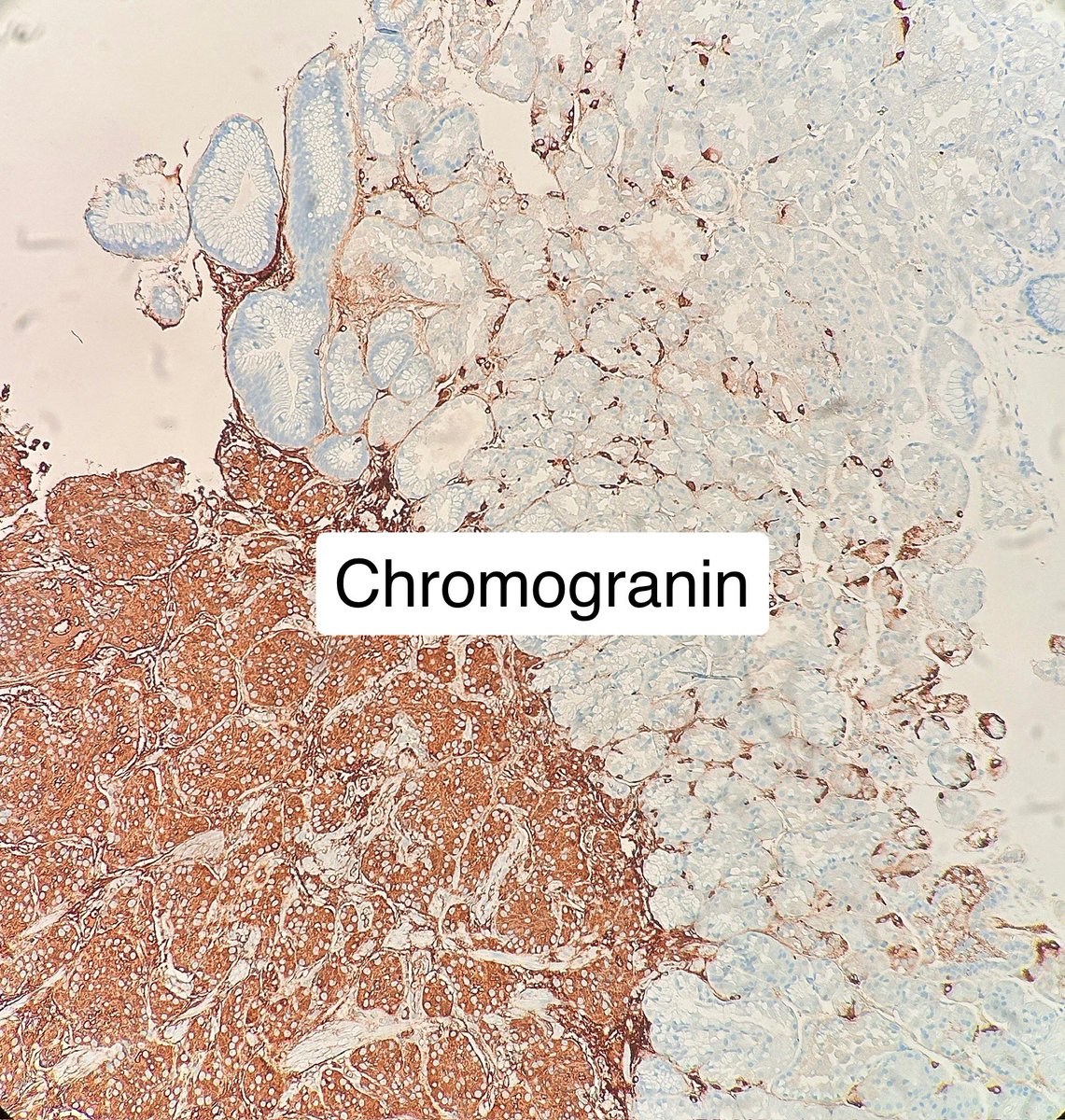 👇 is a Gastric Neuroendocrine Tumor

Did it arise due to AMAG? 🤔 

#pathx #pathtwitter #gipath