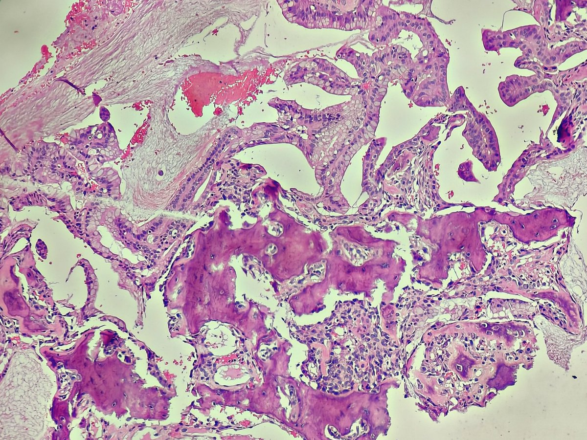 Swathiprabhu5's tweet image. One slide one field. Diagnosis? 
The site is lateral end of clavicle left side
