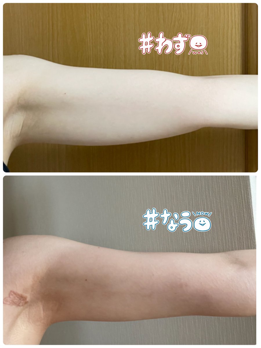 二の腕いい感じ(*˘︶˘*)
たるーんとした振袖部分がなくなって引き締まった！
 #脂肪吸引 #二の腕ベイザー 
#整形垢さんと繋がりたい