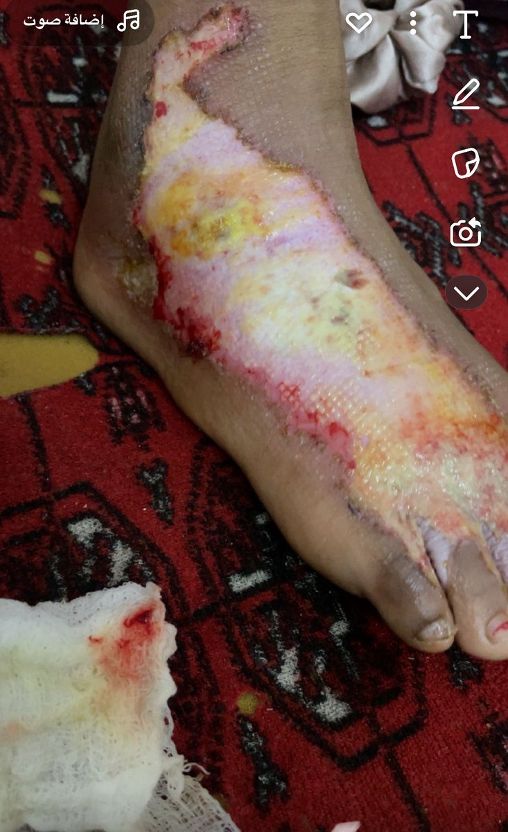 صباح الخير بنتي دعمتها السياره وهي عندها اقامه وانا سعوديه وماعندي ماده للعلاج طالبتكم ياعرب احتاج المعونه رقمي لتواصل اللي حاب يساعد +966562994838