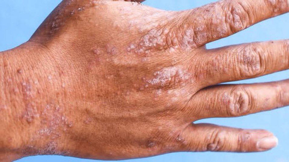 celebritypharm's tweet photo. EVERYTHING YOU NEED TO KNOW ABOUT ECZEMA: 

Eczema is a very common skin condition, but for years, it has been mistaken for Tinea versicolor, making people use the wrong treatment and prolonging their suffering. 

The image at the left is Tinea versicolor and the image at the right represents Eczema.

Let’s learn the causes, symptoms, and prevention of Eczema 

Come with me 👇🏽