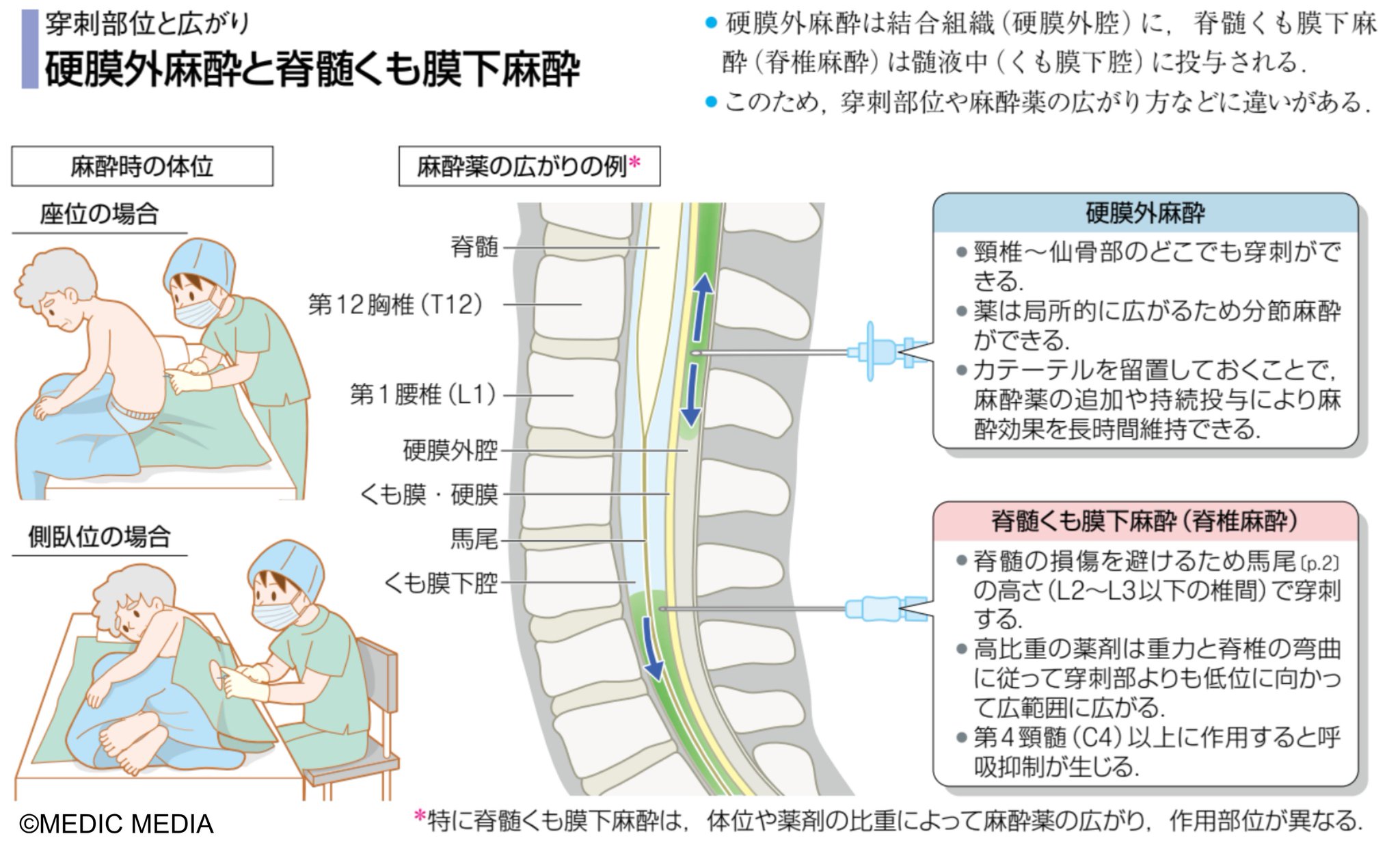 脊髄くも膜下麻酔 病気がみえる on X: 