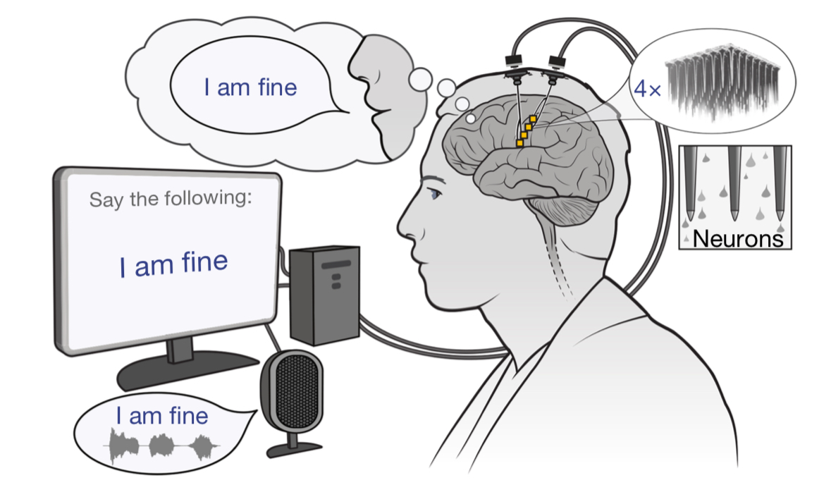 New in <a href="/Nature/">nature</a>: A brain-computer interface that turns thoughts into voice in just 10 milliseconds.

For the first time, someone who lost their speech can ask questions, emphasise words, and sing - all through brain signals alone.

Here's how they did it 🧵