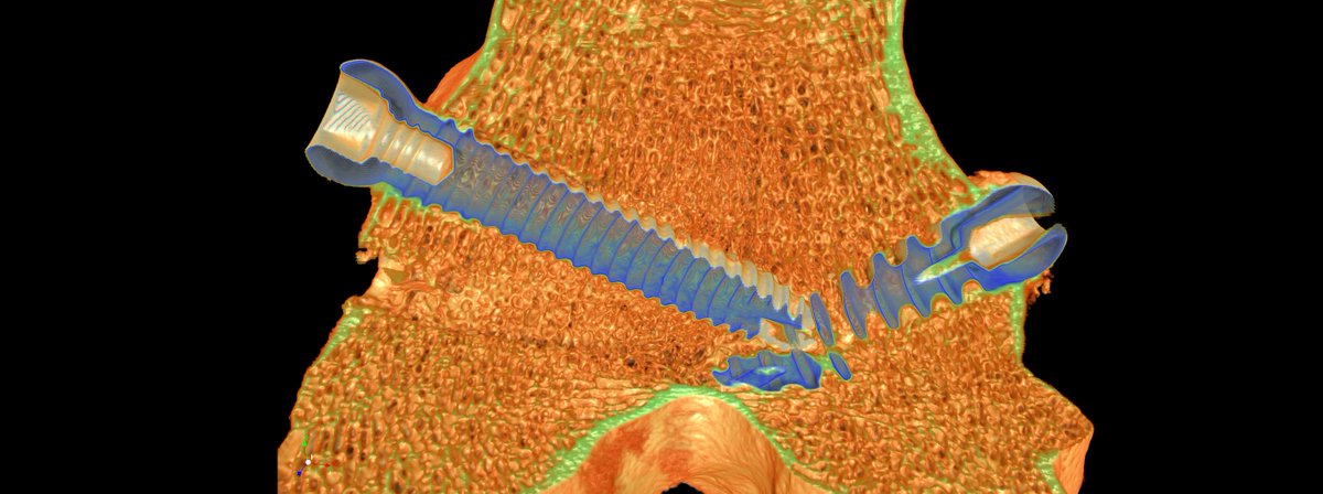 Bruker (@bruker) on Twitter photo The X4 POSEIDON system enables high-resolution imaging of sheep femur with titanium implants 🦴: goto.bruker.com/4423xDZ
#OrthopedicResearch #BoneHealth #MicroCT #X4POSEIDON #Innovation The X4 POSEIDON system enables high-resolution imaging of sheep femur with titanium implants 🦴: goto.bruker.com/4423xDZ
#OrthopedicResearch #BoneHealth #MicroCT #X4POSEIDON #Innovation