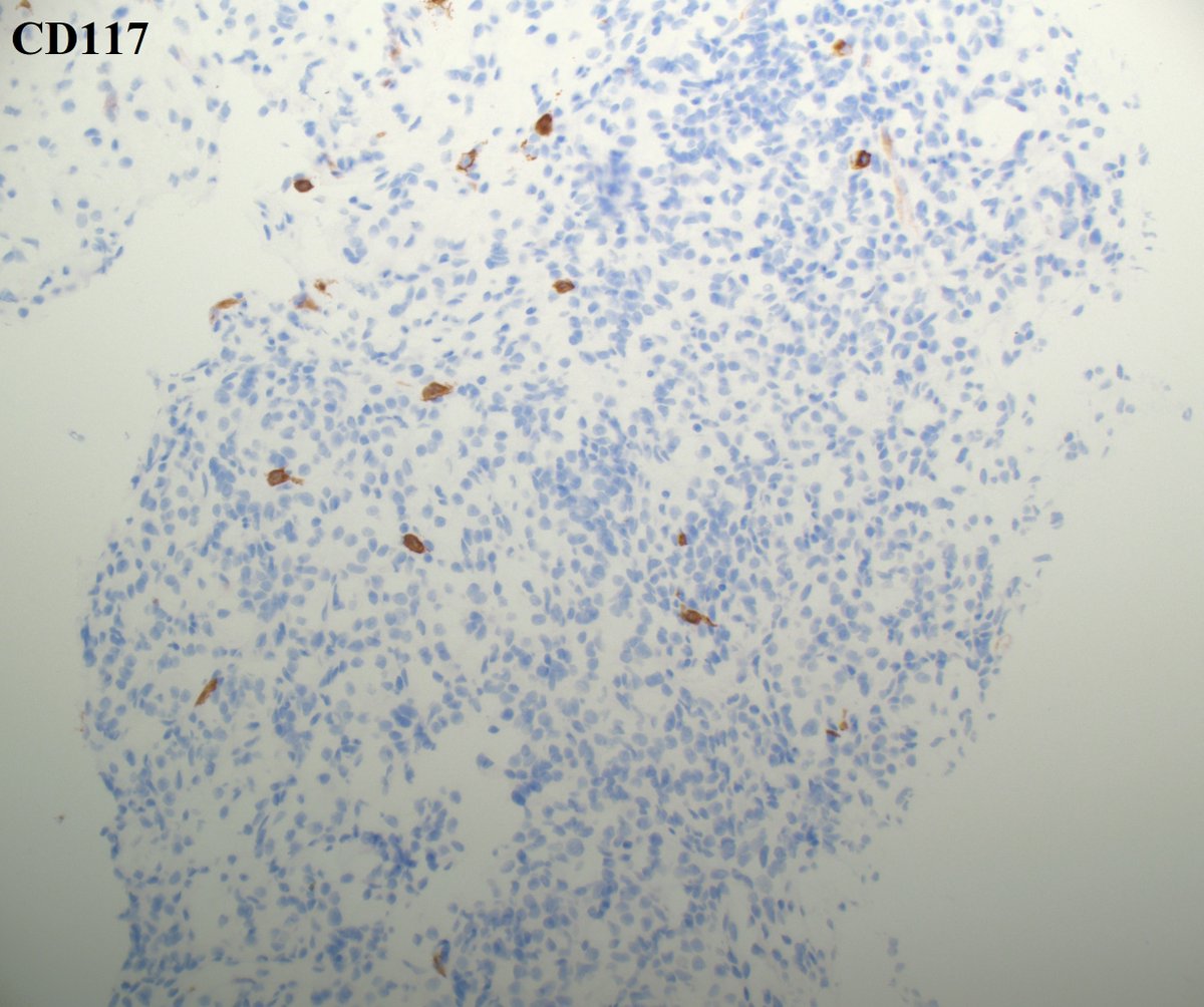 slusagar's tweet image. #pathresidents:

thoughts on interpretation of this study from a #GUpath renal mass bx?

positive?  negative?  equivocal?