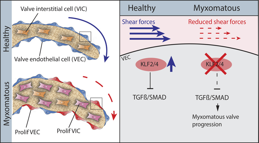 🚨 New Publication: Hemodynamic forces prevent myxomatous valve disease in mice through KLF2/4 signaling jci.org/articles/view/… Congrats Jesse and Dr Khan !!