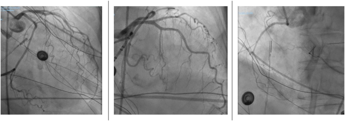 Heart Rhythm Case Reports (@hrs_casereports) on Twitter photo Complication Following Vein of Marshall Ethanol Ablation: A Case of Acute Cardiogenic Shock and Death
<a href="/G_Goldar/">G_Goldar_MD</a>
heartrhythmcasereports.com/article/S2214-… Complication Following Vein of Marshall Ethanol Ablation: A Case of Acute Cardiogenic Shock and Death
<a href="/G_Goldar/">G_Goldar_MD</a>
heartrhythmcasereports.com/article/S2214-…