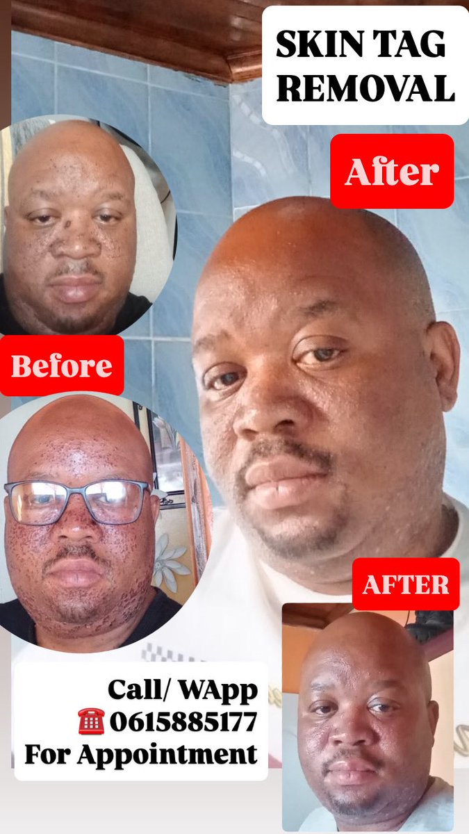 iamsbmazwi's tweet photo. Quick| Pain-free | SKIN TAG REMOVAL (iintsumpa)&amp; razor bumps
Appointments available ☎️ 0615885177 [Sibu| PE | Gqeberha ] #skintagremoval #nomoreskintags #nomoreiintsumpa #nomorerazorbumps #bumpfreeskin #nelsonmandelabay #gqeberha #clearkin https://t.co/2l3jHcGk7H