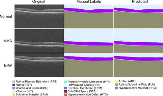 IOVS Journal (@arvoiovs) on Twitter photo Stephen T. C. Wong et al. <a href="/MethodistHosp/">Houston Methodist</a> describe how to identifying retinal features using a self-configuring CNN for clinical intervention.
doi.org/10.1167/iovs.6… Stephen T. C. Wong et al. <a href="/MethodistHosp/">Houston Methodist</a> describe how to identifying retinal features using a self-configuring CNN for clinical intervention.
doi.org/10.1167/iovs.6…